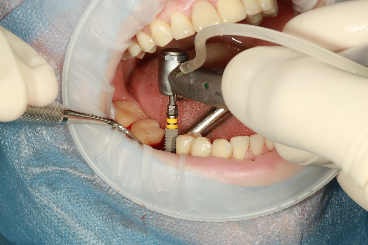 dental implant photo